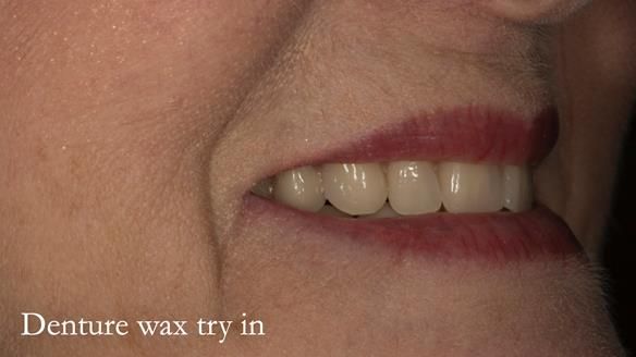 Newsletter 75: Marion’s case - Step-by-step complete denture workflow