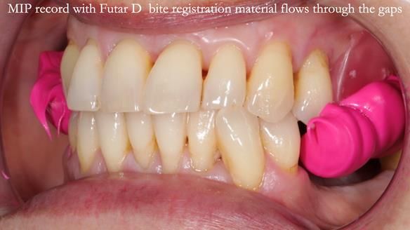 Newsletter 56 showing the making and fitting of a bilateral free end saddle upper removable partial denture (RPD) for patient with pemphigus