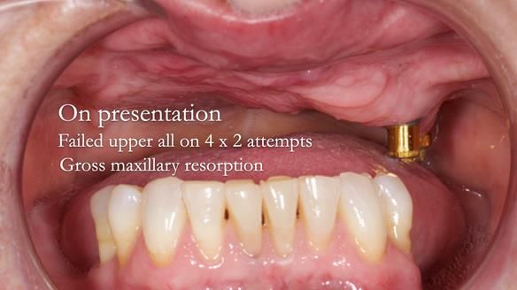 Solving Linda’s Failed “All on 4” implant bridges - full protocol Newsletter 42