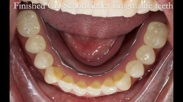 Finlay's Newsletter 62 provision of extractions and metal based complete dentures for Rafique