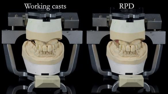 Newsletter 56 showing the making and fitting of a bilateral free end saddle upper removable partial denture (RPD) for patient with pemphigus