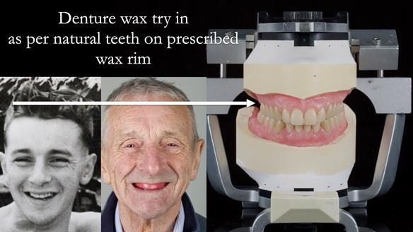 Newsletter 80 - Gordon’s dentures: the one case in 1,000 where my technique failed