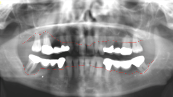 Figure 7 OPG radiograph supplied by the referring GDP showing reduced bone levels on posterior teeth.