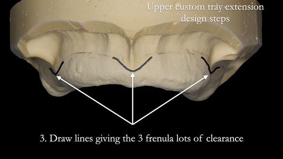 Newsletter 50 Special edition Complete Dentures FULL PROTOCOL