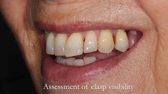 Newsletter 56 showing the making and fitting of a bilateral free end saddle upper removable partial denture (RPD) for patient with pemphigus
