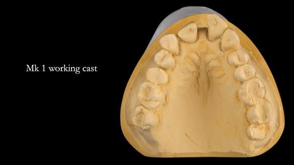 Finlay's Newsletter 63 Case study provision of metal based Scandinavian RPD - functional 10 years on