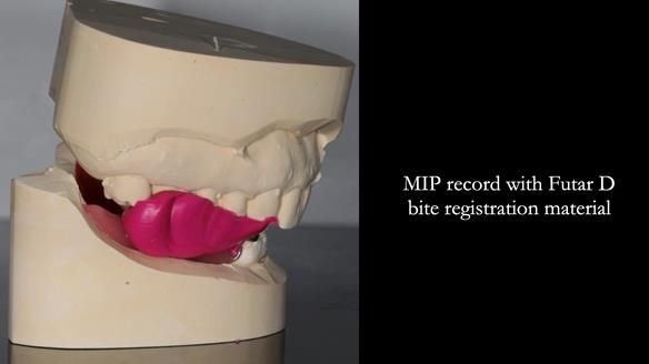 Finlay's Newsletter 61 provision of a lower unilateral free end saddle metal based partial denture for Joyce