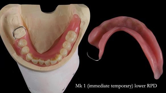 Newsletter 82 Mary - A complete upper and a one-tooth gasket denture