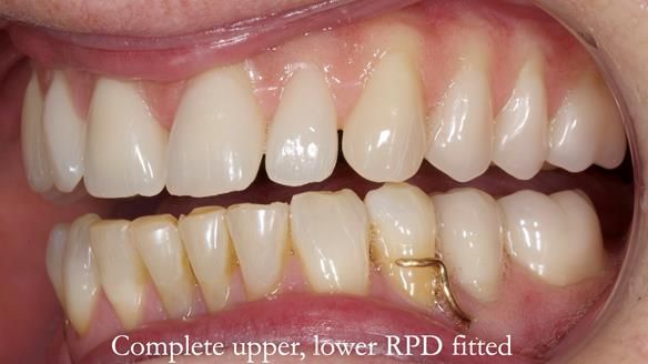 Solving Linda’s Failed “All on 4” implant bridges - full protocol Newsletter 42