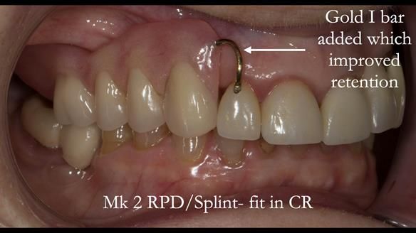 Newsletter 51 Managing Anne’s failing dentition with distal extension base RPD/Splint FULL PROTOCOL