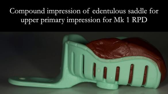 Finlay's Case Study Newsletter 40 - Immediate Mk 1 RPD to Definitive Mk 2 RPD - full protocol