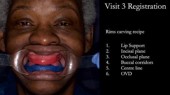 Newsletter 53 showing the making and fitting of ultra life-like dentures for Valena