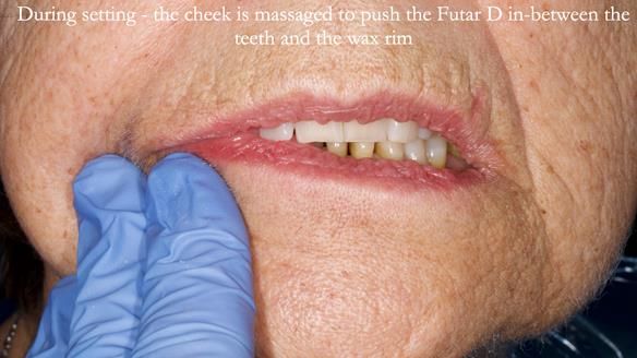 Finlay's Newsletter 61 provision of a lower unilateral free end saddle metal based partial denture for Joyce