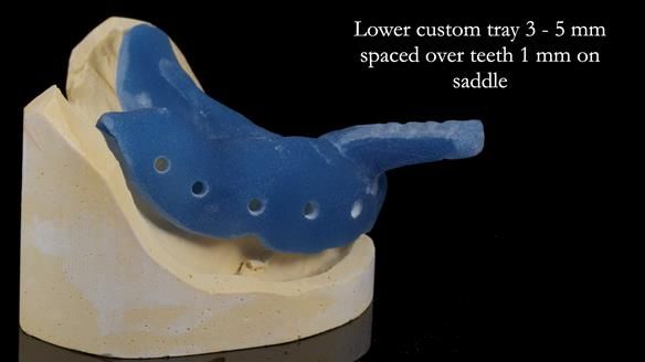 Newsletter 55 Provision of metal based partial dentures for Zephyrine with a repaired cleft lip and palate