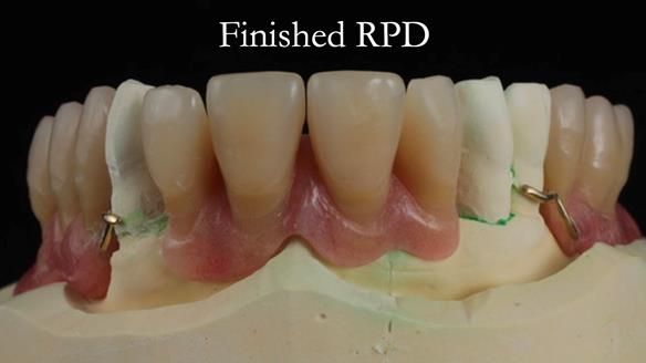 Finlay's Newsletter 59 Ultra hard partial dentures made for Gill