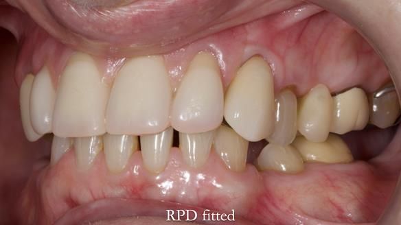 Newsletter 81 - Pam’s Story — how a partial denture changed her life (+ live walkthrough this Thursday)