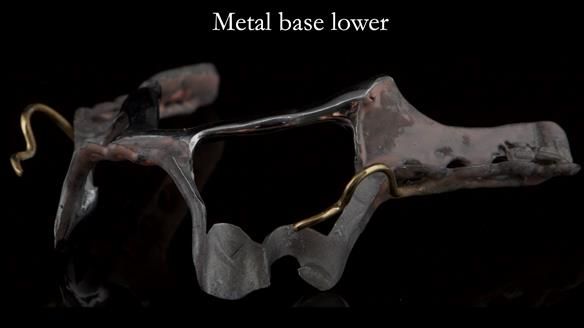 Finlay's Case Study Newsletter 40 - Immediate Mk 1 RPD to Definitive Mk 2 RPD - full protocol