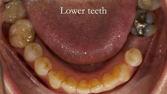 Solving Sue's failed implants with metal based RPD - full protocol Newsletter 43