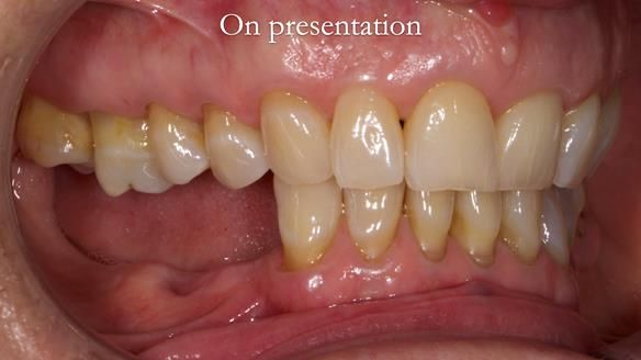 Finlay's Newsletter 61 provision of a lower unilateral free end saddle metal based partial denture for Joyce