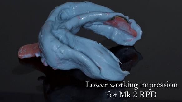 Finlay's Case Study Newsletter 40 - Immediate Mk 1 RPD to Definitive Mk 2 RPD - full protocol