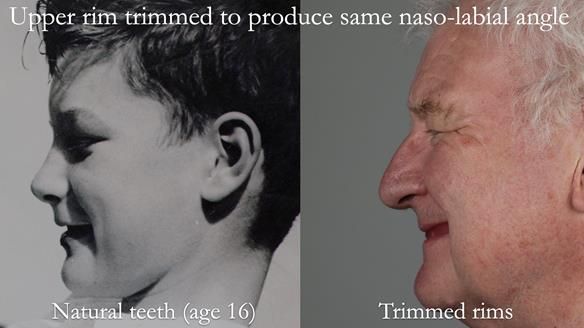 Newsletter 57 showcases the making and fitting process of implant-supported complete dentures for Alisdair
