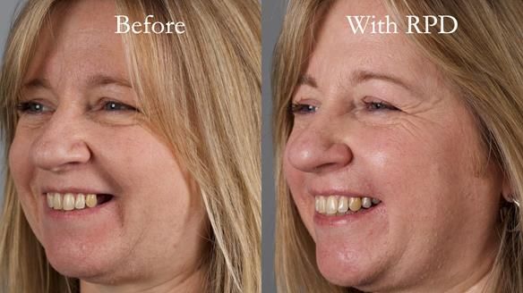 Solving Sue's failed implants with metal based RPD - full protocol Newsletter 43