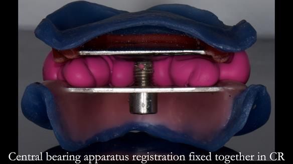 Newsletter 83: Sheila’s Complete Denture Success