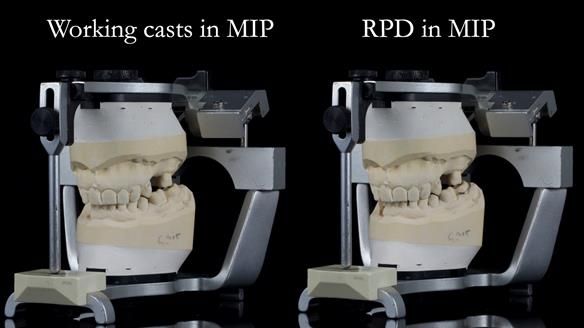 Finlay's Newsletter 61 provision of a lower unilateral free end saddle metal based partial denture for Joyce