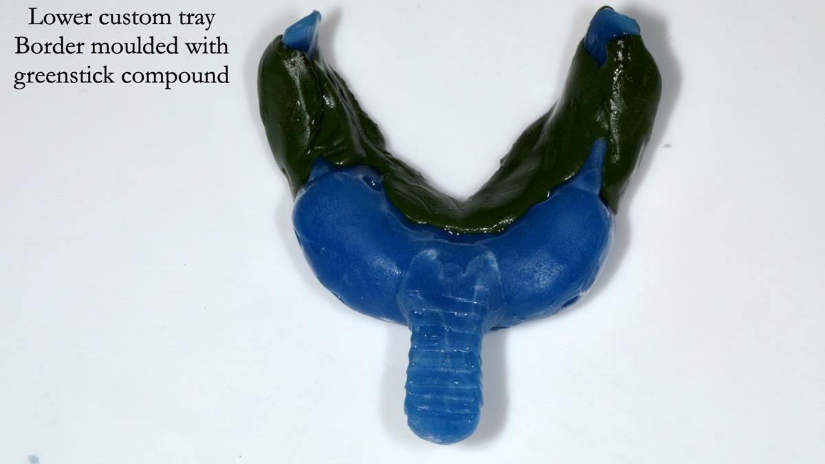 Newsletter 87 – Father Peter: A Partial Denture that needed Minor Miracle