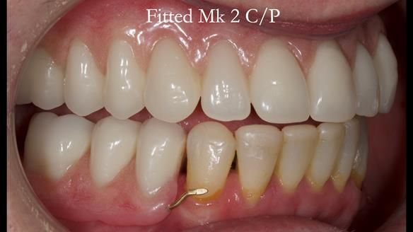Newsletter 52 Managing Jo’s failing dentition with extractions and Mk 1/Mk 2 complete upper dentures and lower partial dentures FULL PROTOCOL