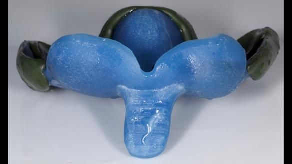 Newsletter 77: Jeremy’s case – immediate complete upper denture