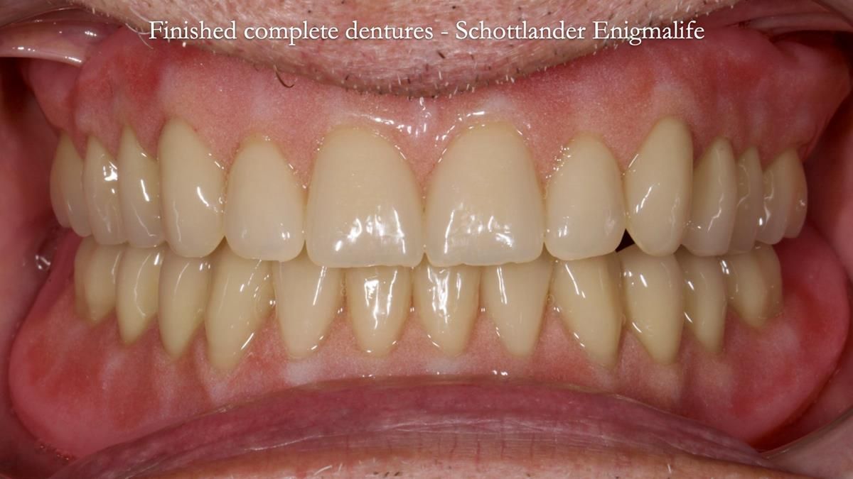 Fin’s Newsletter 88 — Complete dentures - full protocol… he rearranged his own teeth!