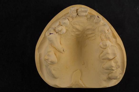 Figure 19 Cast for making the immediate complete denture with full depth of the sulcus recorded