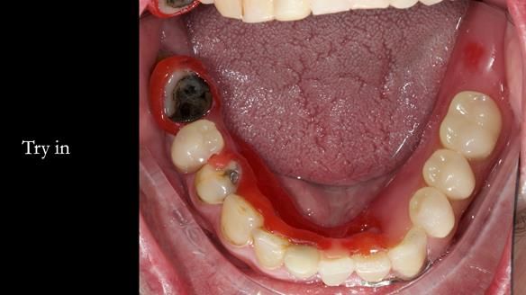 Newsletter 55 Provision of metal based partial dentures for Zephyrine with a repaired cleft lip and palate