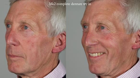 Newsletter 77: Jeremy’s case – immediate complete upper denture