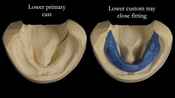 Newsletter 83: Sheila’s Complete Denture Success