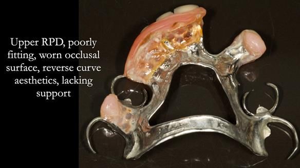 Eileen's transformation with upper and lower RPDs of Scandinavian hygienic design FULL PROTOCOL