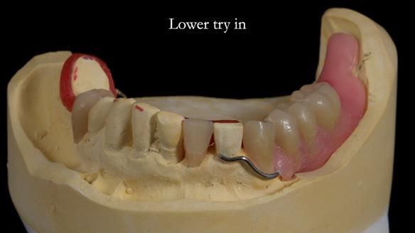 Newsletter 55 Provision of metal based partial dentures for Zephyrine with a repaired cleft lip and palate