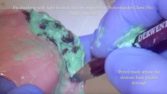 Finlay's Newsletter 62 provision of extractions and metal based complete dentures for Rafique