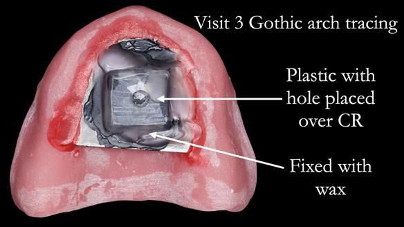 Newsletter 50 Special edition Complete Dentures FULL PROTOCOL