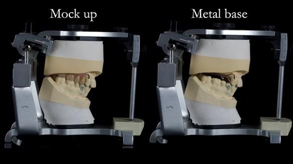 Newsletter 56 showing the making and fitting of a bilateral free end saddle upper removable partial denture (RPD) for patient with pemphigus