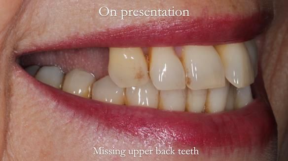 Newsletter 56 showing the making and fitting of a bilateral free end saddle upper removable partial denture (RPD) for patient with pemphigus
