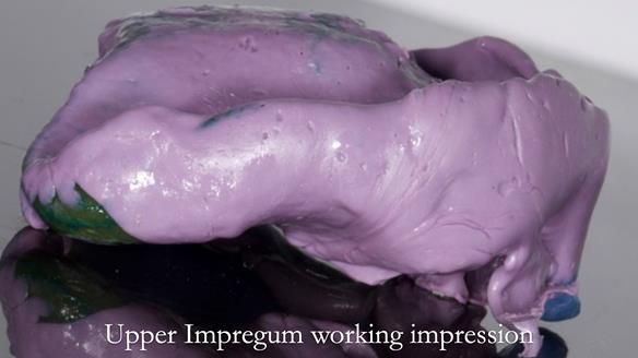 Newsletter 57 showcases the making and fitting process of implant-supported complete dentures for Alisdair