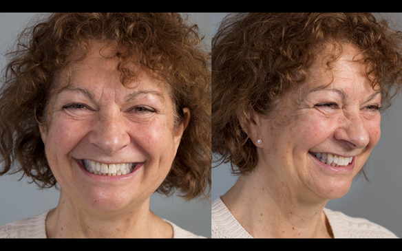 Figure 68 The patient assesses a video of the try in, still photographs and in a mirror.