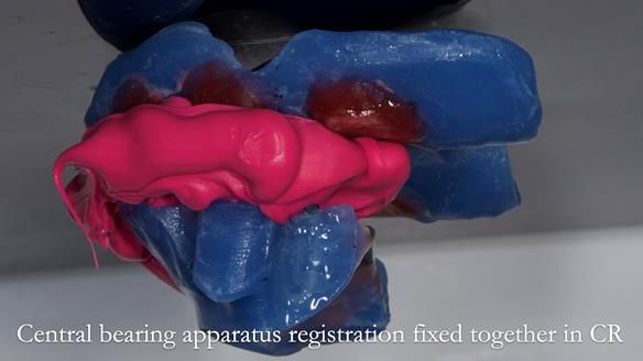 Newsletter 77: Jeremy’s case – immediate complete upper denture