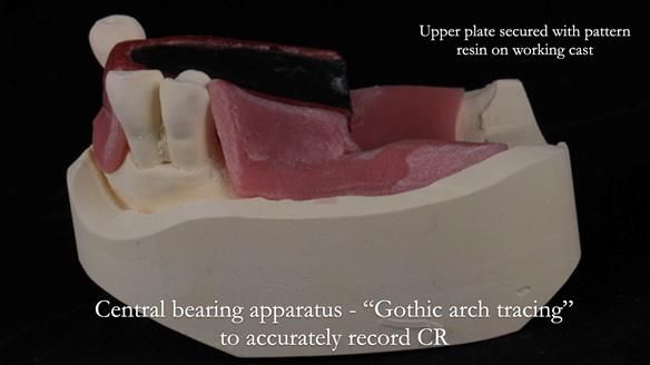 Finlay's Newsletter 59 Ultra hard partial dentures made for Gill