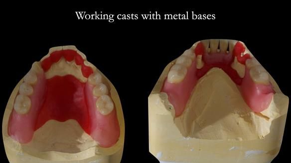 Finlay's Case Study Newsletter 40 - Immediate Mk 1 RPD to Definitive Mk 2 RPD - full protocol