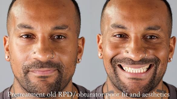 Acrylic based partial denture/obturator had poor, retention and support Obturator section was in poor condition. The Adams clasp were causing inflammation of the gingival margins. The clasp on the UR3 was visible resulting in poor appearance. Reduced lip