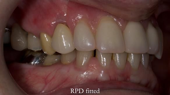 Newsletter 81 - Pam’s Story — how a partial denture changed her life (+ live walkthrough this Thursday)