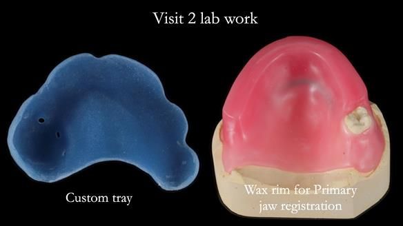 Finlay's Newsletter 58 Gasket upper partial denture for Zoe